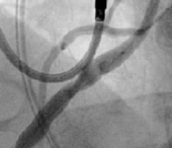Prior to stent deployment