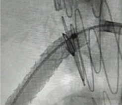 Stent protruding into aorta
