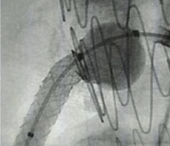 Post-dilatation with FLASH