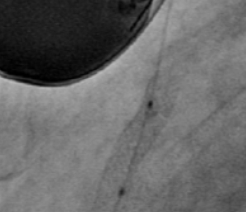 Stent protruding into aorta