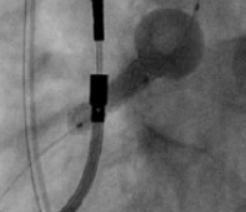 Post-dilatation with FLASH